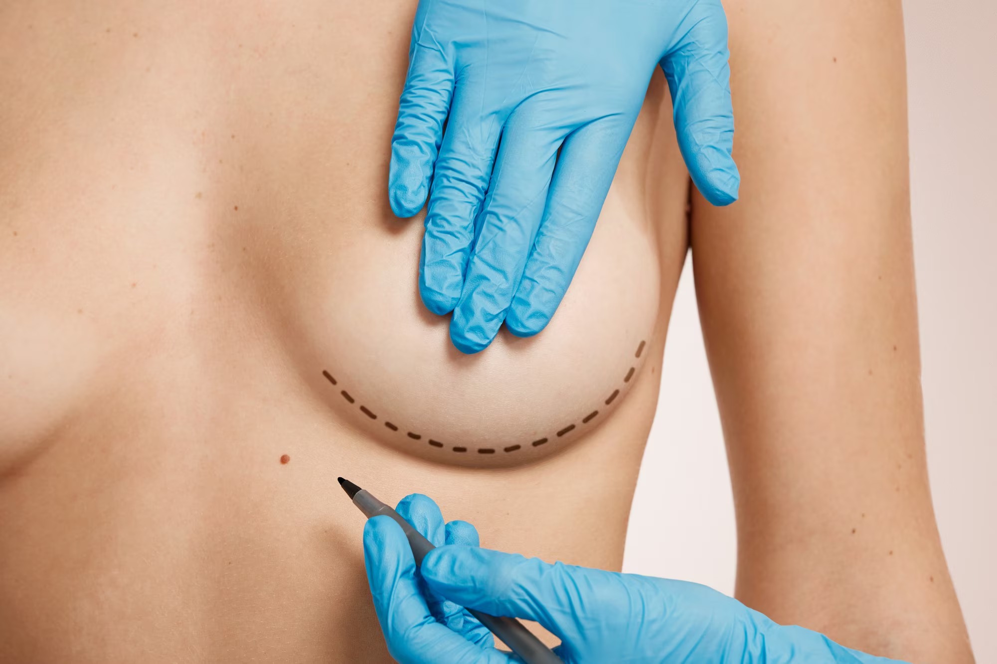 Mamoplastia de aumento o reducción